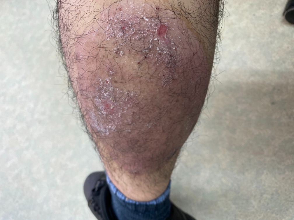 注射スタート 二週間後